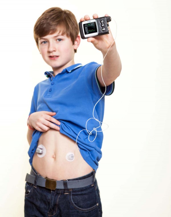 Die Animas® Vibe™ Insulinpumpe mit Dexcom G4™ PLATINUM CGM-System ist jetzt für kleine Typ-1-Diabetiker zugelassen. Foto: Animas