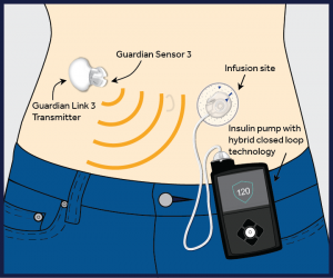 Medtronic 670G