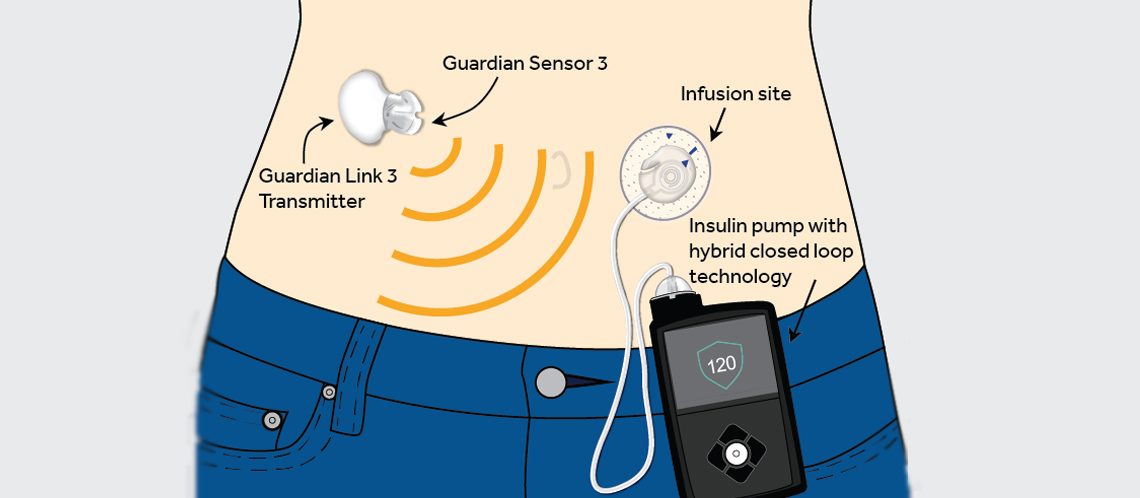 Medtronic 670G erhältlich bei DIASHOP