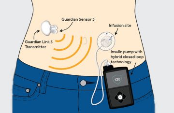 Medtronic 670G erhältlich bei DIASHOP