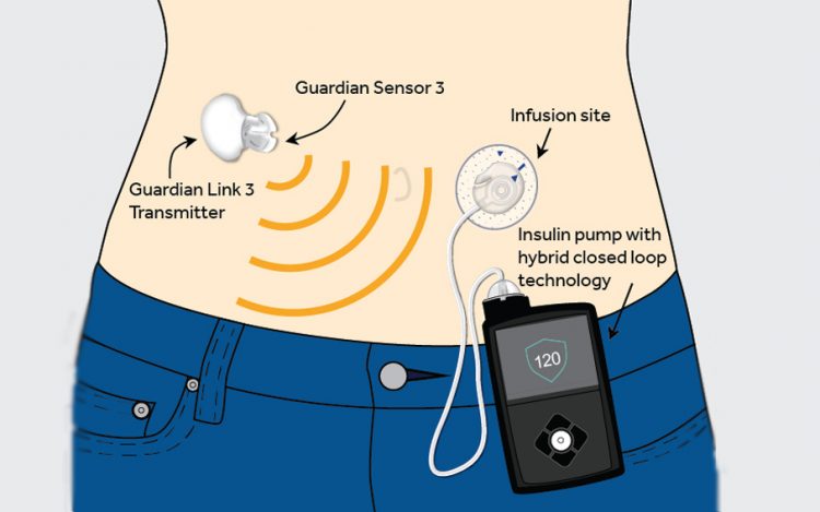 Medtronic 670G erhältlich bei DIASHOP