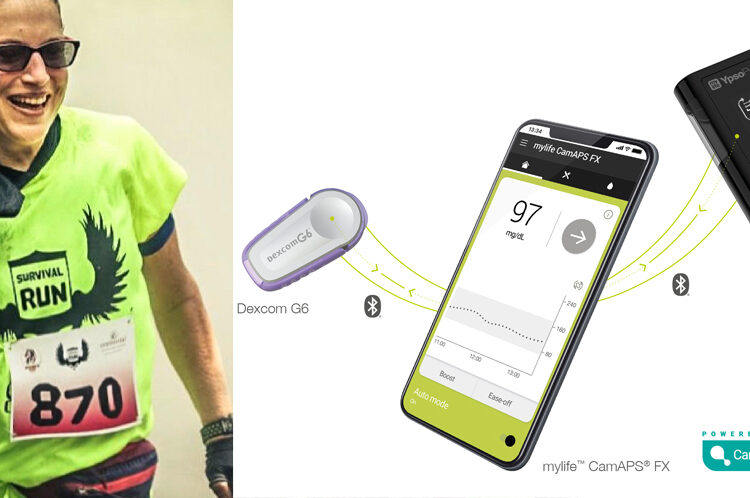 erste erfahrungen mit mylife loop